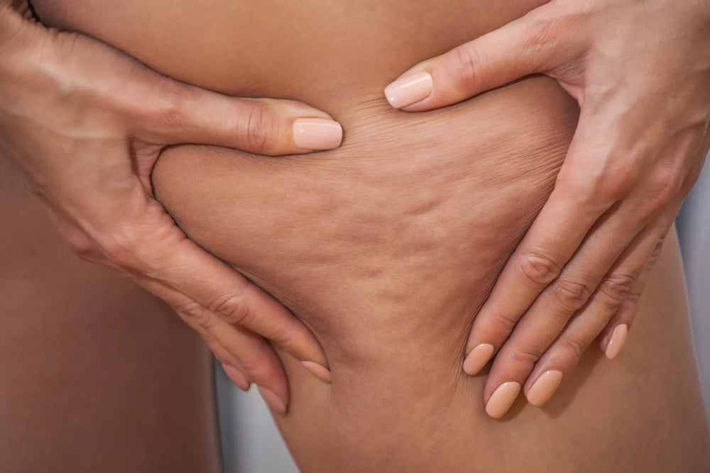 Lipedema vs. Cellulite: What Are the Differences?