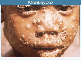 Monkeypox: Causes, Prevention, Treatment Vaccination and more