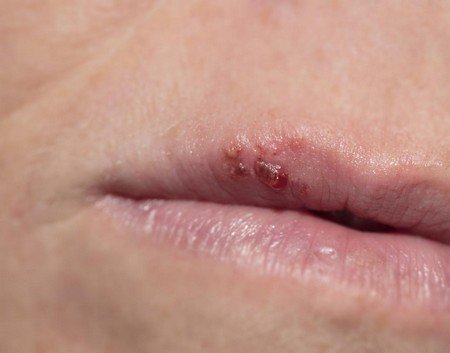 Natural Treatment for Cold Sores is Safe and Cheap