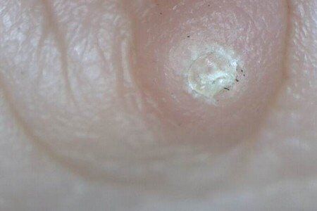 Know About Warts symptoms and Treatments with Prevention Tips
