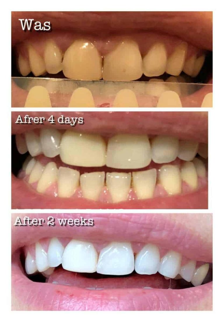 Achieve a Brighter Smile: The Benefits of Professional Teeth Whitening