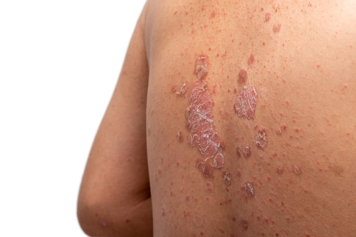 Takeda Drug From $4B Deal Succeeds in Two Pivotal Plaque Psoriasis Trials