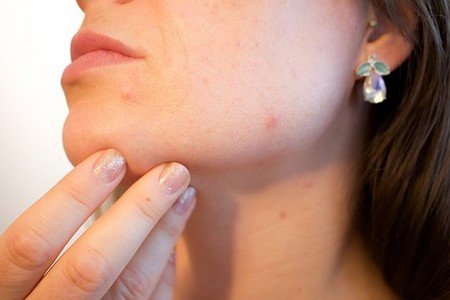 acne causes to know before acne treatment
