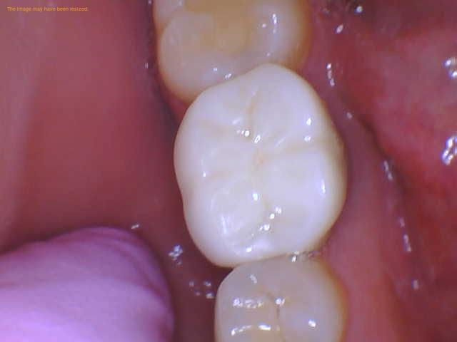 Reason for Gum Pain After Implant Crown Placement