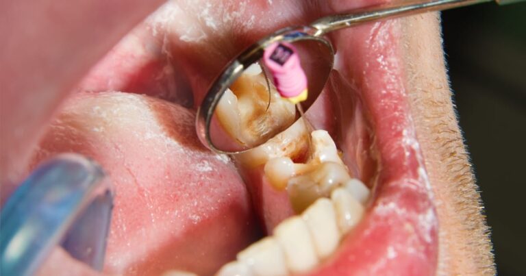 Endodontic Surgery: Root Canal And Apicoectomy Explained