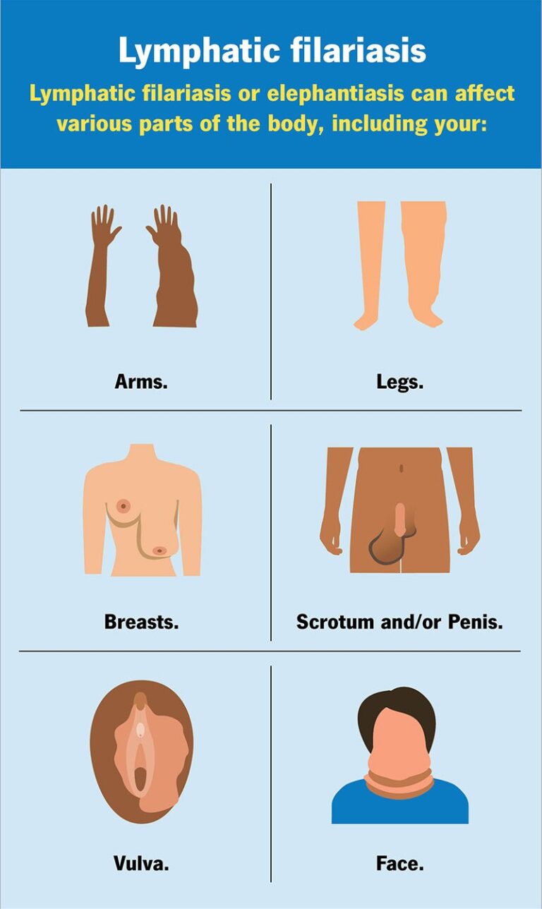 Filariasis: Causes, Prevention and Treatment