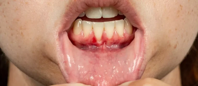 Gum Recession: Causes, Prevention & Treatment And Advice
