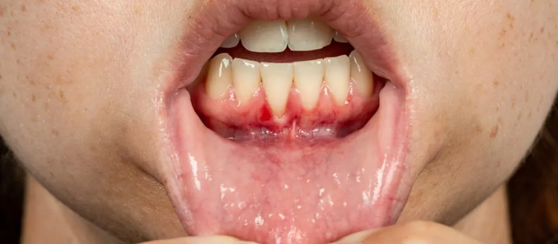 gum recession