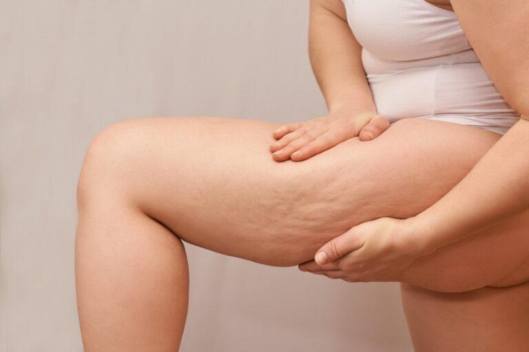 Collagen for Cellulite: Can It Really Help?
