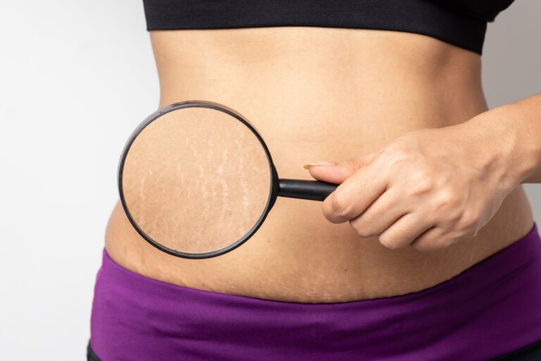 Collagen for Stretch Marks: Can It Help Fade Them?