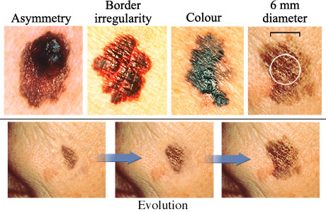 ABCDE Rule for Melanoma: A Complete Guide to the Skin Self-Exam
