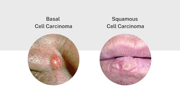 Basal Cell Carcinoma vs. Squamous Cell Carcinoma: Key Differences