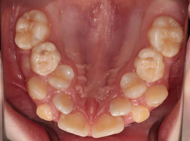 What Causes Crowded Teeth in Children? Causes, Signs, and Next Steps